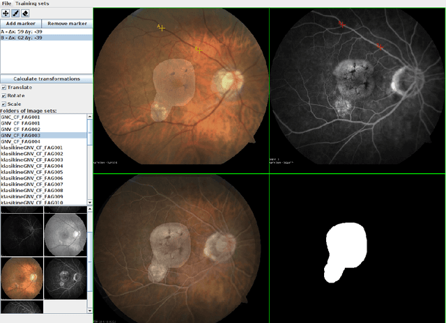 Figure 1 for Automated age-related macular degeneration area estimation -- first results