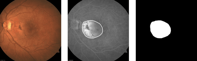 Figure 3 for Automated age-related macular degeneration area estimation -- first results