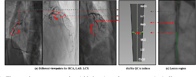 Figure 1 for Direct Quantification for Coronary Artery Stenosis Using Multiview Learning