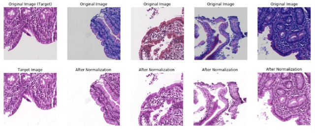 Figure 1 for Deep Learning for Visual Recognition of Environmental Enteropathy and Celiac Disease