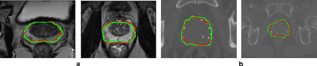 Figure 4 for Deep generative model-driven multimodal prostate segmentation in radiotherapy