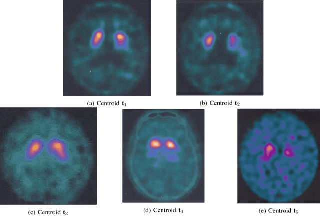 Figure 3 for Predicting Parkinson's Disease using Latent Information extracted from Deep Neural Networks