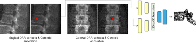 Figure 1 for Inferring the 3D Standing Spine Posture from 2D Radiographs