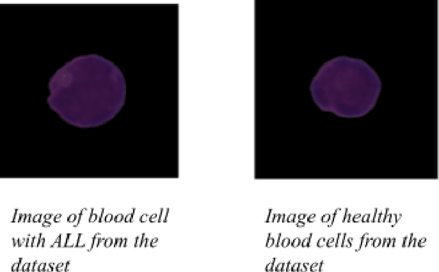 Figure 1 for ALLNet: A Hybrid Convolutional Neural Network to Improve Diagnosis of Acute Lymphocytic Leukemia (ALL) in White Blood Cells