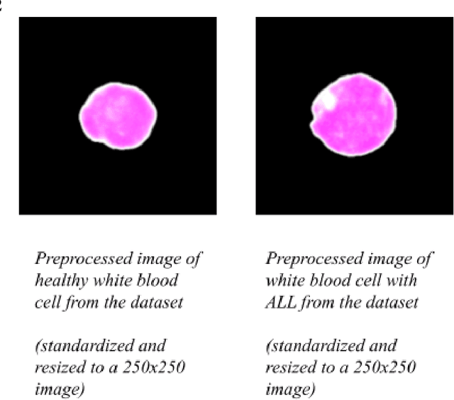 Figure 3 for ALLNet: A Hybrid Convolutional Neural Network to Improve Diagnosis of Acute Lymphocytic Leukemia (ALL) in White Blood Cells