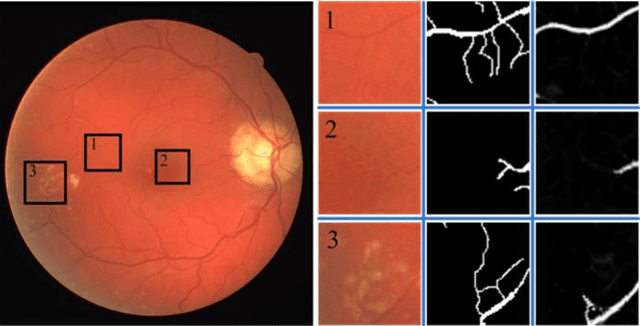 Figure 1 for A Symmetric Equilibrium Generative Adversarial Network with Attention Refine Block for Retinal Vessel Segmentation