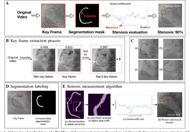 Figure 1 for Automated Deep Learning Analysis of Angiography Video Sequences for Coronary Artery Disease