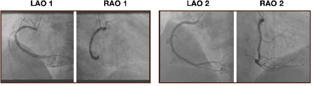 Figure 2 for Automated Deep Learning Analysis of Angiography Video Sequences for Coronary Artery Disease