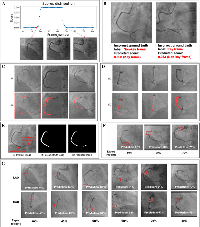 Figure 3 for Automated Deep Learning Analysis of Angiography Video Sequences for Coronary Artery Disease
