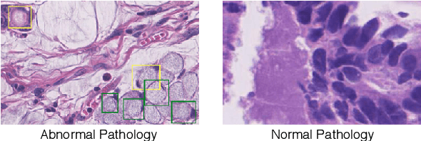 Figure 1 for Decoupled Gradient Harmonized Detector for Partial Annotation: Application to Signet Ring Cell Detection