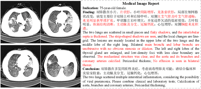 Figure 1 for Medical-VLBERT: Medical Visual Language BERT for COVID-19 CT Report Generation With Alternate Learning