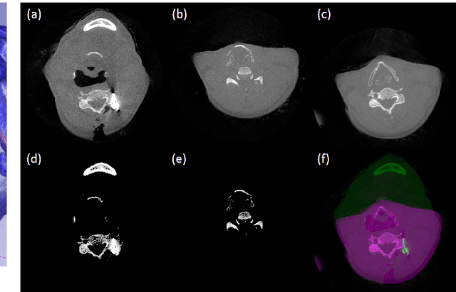 Figure 3 for Metal Artifact Reduction in Cone-Beam X-Ray CT via Ray Profile Correction