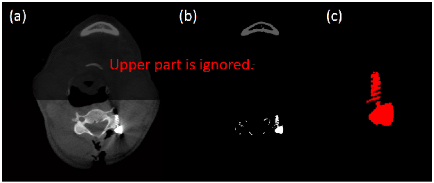 Figure 4 for Metal Artifact Reduction in Cone-Beam X-Ray CT via Ray Profile Correction