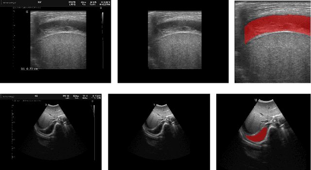 Figure 1 for Deep Learning-based Segmentation of Pleural Effusion From Ultrasound Using Coordinate Convolutions