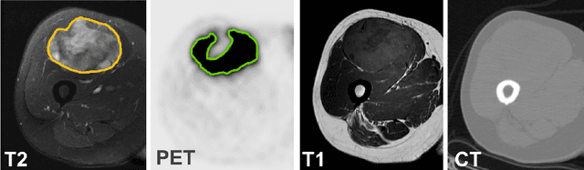 Figure 1 for Soft Tissue Sarcoma Co-Segmentation in Combined MRI and PET/CT Data
