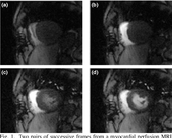 Figure 1 for Automated quantitative analysis of first-pass myocardial perfusion magnetic resonance imaging data