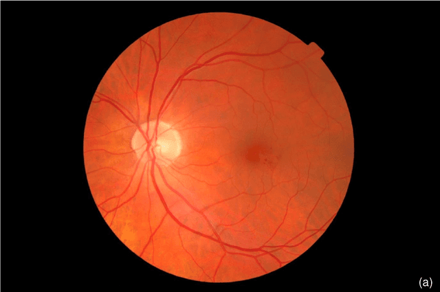 Figure 2 for Instant automatic diagnosis of diabetic retinopathy