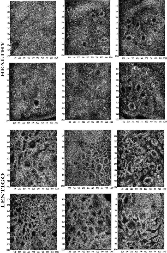 Figure 1 for An unsupervised bayesian approach for the joint reconstruction and classification of cutaneous reflectance confocal microscopy images