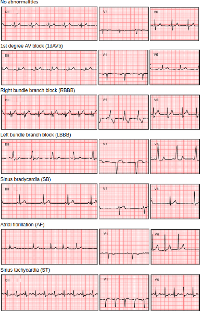 Figure 4 for Automatic Diagnosis of Short-Duration 12-Lead ECG using a Deep Convolutional Network