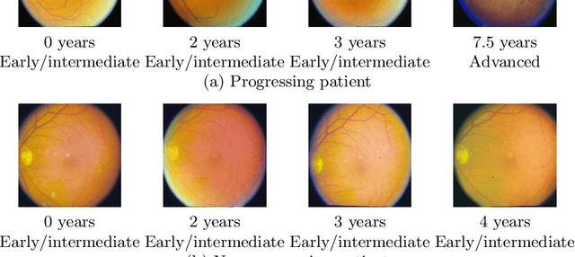 Figure 3 for Development and Validation of a Novel Prognostic Model for Predicting AMD Progression Using Longitudinal Fundus Images