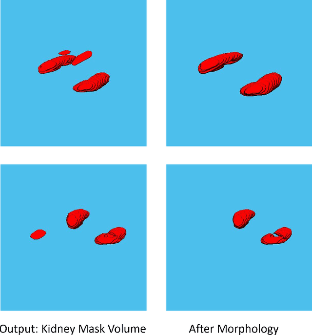Figure 3 for Automated Kidney Segmentation by Mask R-CNN in T2-weighted Magnetic Resonance Imaging
