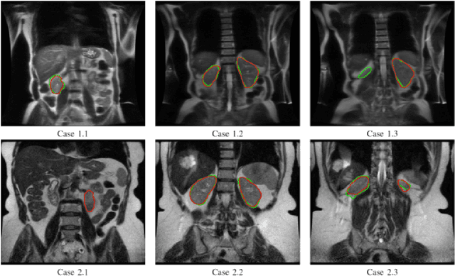 Figure 4 for Automated Kidney Segmentation by Mask R-CNN in T2-weighted Magnetic Resonance Imaging
