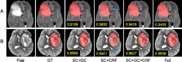 Figure 3 for Scribble-based Hierarchical Weakly Supervised Learning for Brain Tumor Segmentation