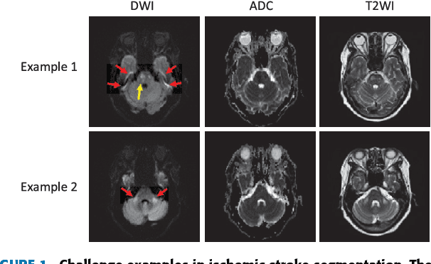 Figure 1 for Towards Clinical Diagnosis: Automated Stroke Lesion Segmentation on Multimodal MR Image Using Convolutional Neural Network