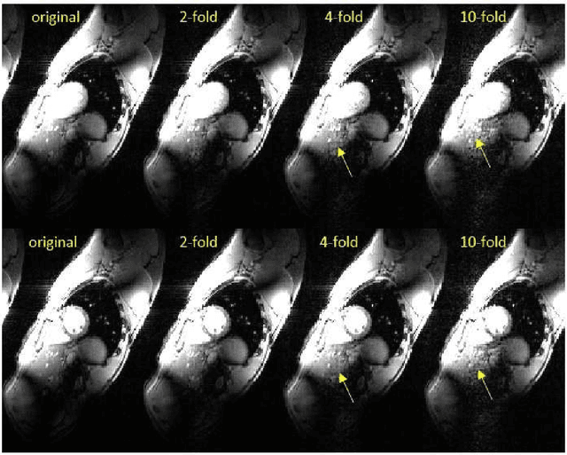 Figure 3 for Tracking Tensor Subspaces with Informative Random Sampling for Real-Time MR Imaging