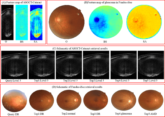 Figure 4 for Attention-based Saliency Hashing for Ophthalmic Image Retrieval