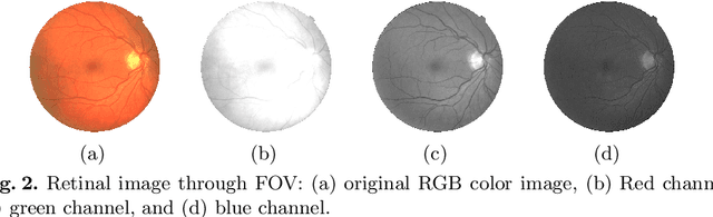 Figure 3 for Automated retinal vessel segmentation based on morphological preprocessing and 2D-Gabor wavelets