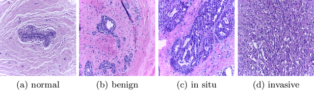 Figure 1 for Reinforced Auto-Zoom Net: Towards Accurate and Fast Breast Cancer Segmentation in Whole-slide Images