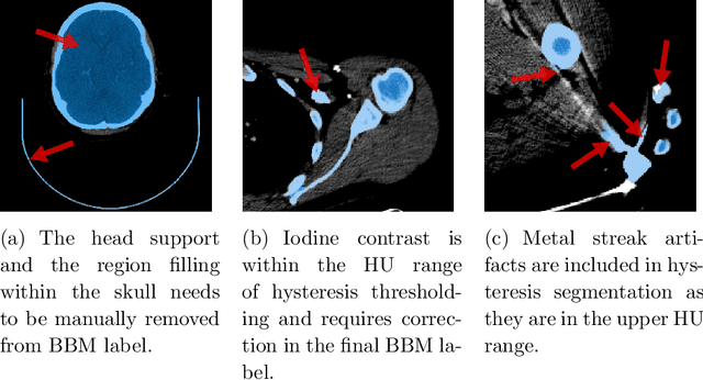 Figure 2 for Bone Segmentation in Contrast Enhanced Whole-Body Computed Tomograph
