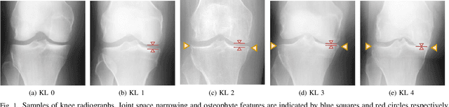 Figure 1 for Semixup: In- and Out-of-Manifold Regularization for Deep Semi-Supervised Knee Osteoarthritis Severity Grading from Plain Radiographs