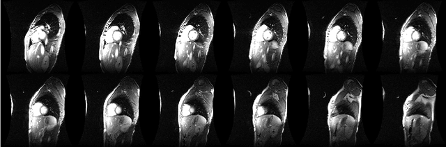 Figure 4 for Dependent Nonparametric Bayesian Group Dictionary Learning for online reconstruction of Dynamic MR images