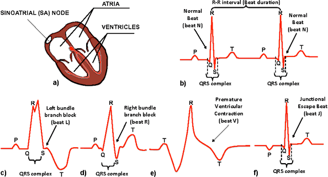 Figure 1 for Learning Temporal Logical Properties Discriminating ECG models of Cardiac Arrhytmias