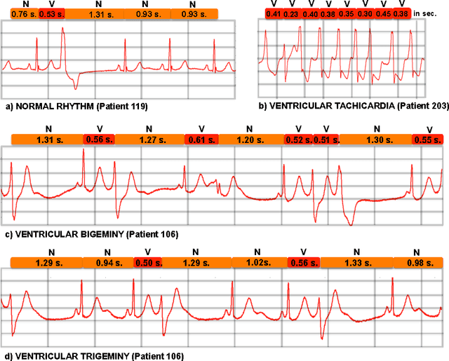 Figure 3 for Learning Temporal Logical Properties Discriminating ECG models of Cardiac Arrhytmias