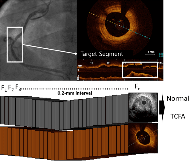 Figure 3 for Automated detection of vulnerable plaque in intravascular ultrasound images