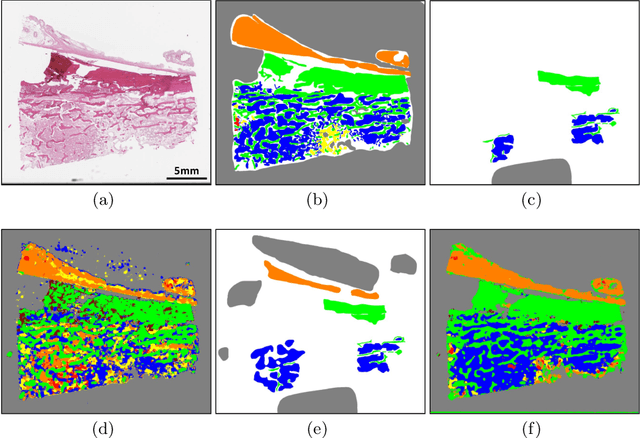 Figure 3 for Deep Interactive Learning: An Efficient Labeling Approach for Deep Learning-Based Osteosarcoma Treatment Response Assessment