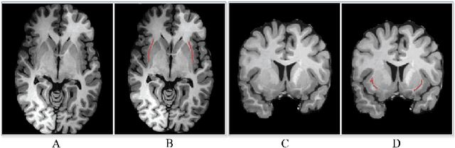Figure 1 for Complex Grey Matter Structure Segmentation in Brains via Deep Learning: Example of the Claustrum