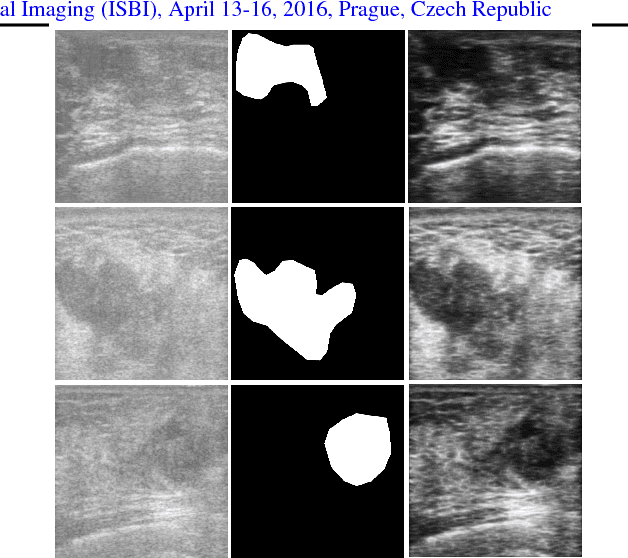 Figure 3 for Tumour ROI Estimation in Ultrasound Images via Radon Barcodes in Patients with Locally Advanced Breast Cancer