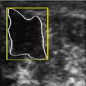 Figure 4 for Tumour ROI Estimation in Ultrasound Images via Radon Barcodes in Patients with Locally Advanced Breast Cancer