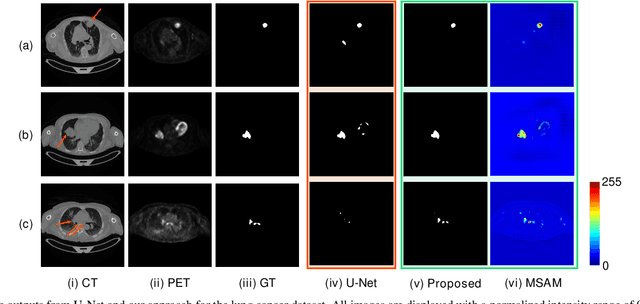 Figure 2 for Multimodal Spatial Attention Module for Targeting Multimodal PET-CT Lung Tumor Segmentation