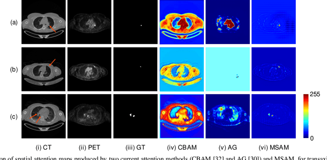 Figure 4 for Multimodal Spatial Attention Module for Targeting Multimodal PET-CT Lung Tumor Segmentation