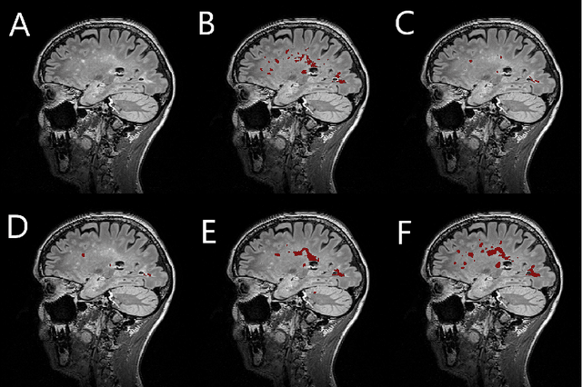 Figure 1 for Simultaneous lesion and neuroanatomy segmentation in Multiple Sclerosis using deep neural networks