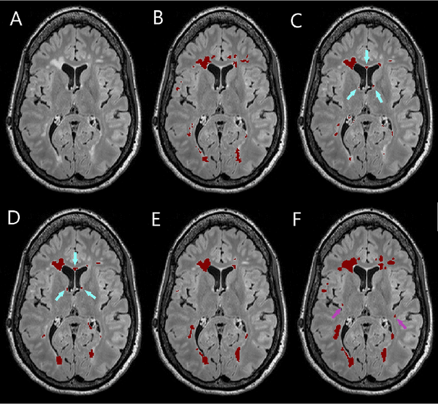 Figure 2 for Simultaneous lesion and neuroanatomy segmentation in Multiple Sclerosis using deep neural networks