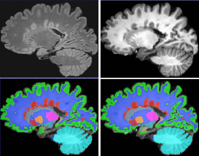 Figure 3 for Simultaneous lesion and neuroanatomy segmentation in Multiple Sclerosis using deep neural networks