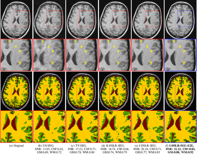 Figure 3 for Reconstruction and Segmentation of Parallel MR Data using Image Domain DEEP-SLR