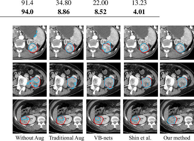 Figure 4 for Automatic Data Augmentation via Deep Reinforcement Learning for Effective Kidney Tumor Segmentation
