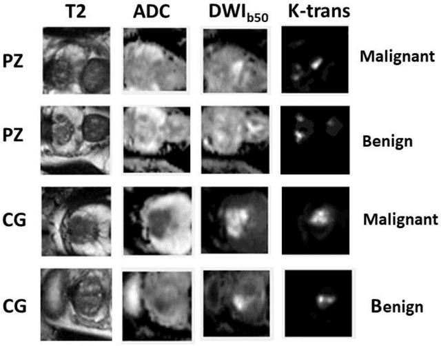 Figure 2 for A Deep Dive into Understanding Tumor Foci Classification using Multiparametric MRI Based on Convolutional Neural Network